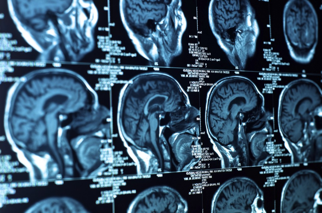 Magnetic Resonance Imaging (MRI).